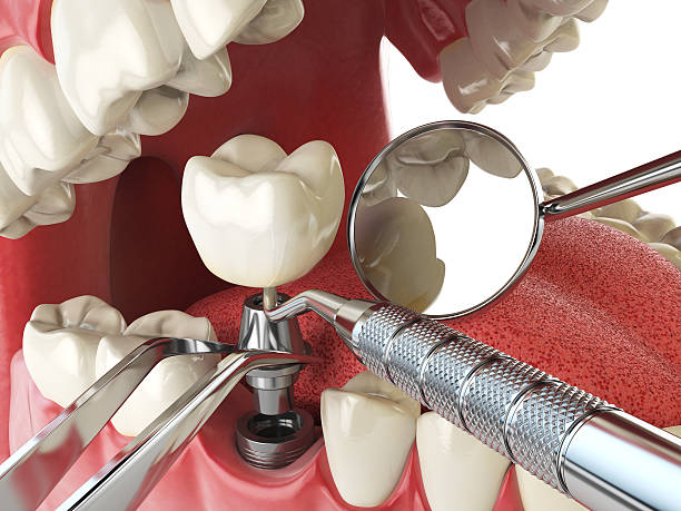 Best Emergency Dental Care for Trauma or Injury in Glasgow, MO